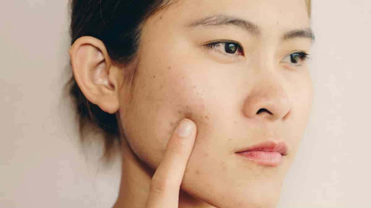 Manchas de acne Como remover as marcas de espinhas do rosto